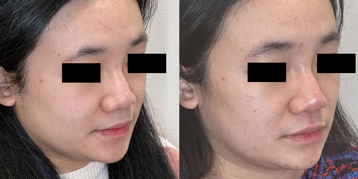 Liquid-Rhinoplasty-using-Restylane-Kysse-13